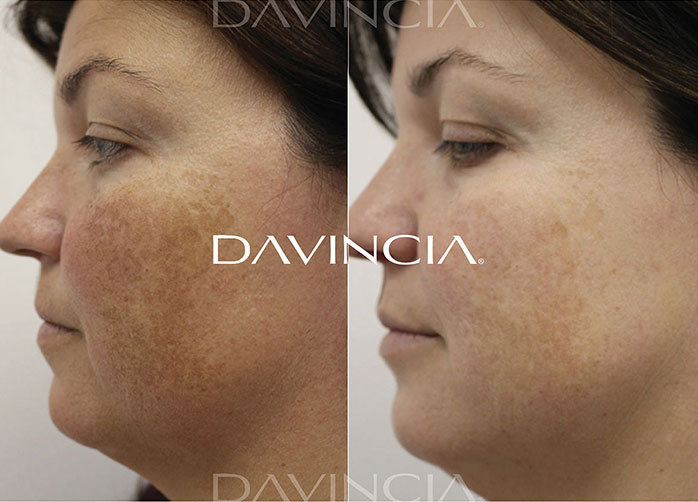 Soin Davincia avant-après