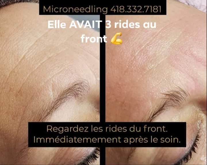 Microneedling rides - Avant-après