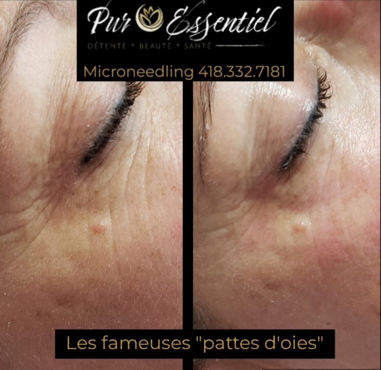 Microneedling pattes d'oies - Avant-après