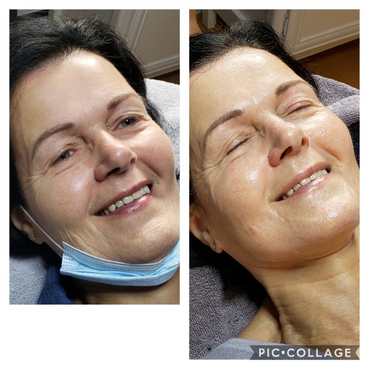 Peeling Image Skincare avant-après