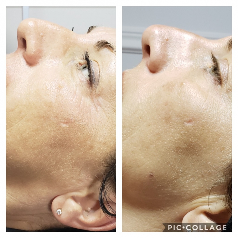 Peeling Image Skincare avant-après