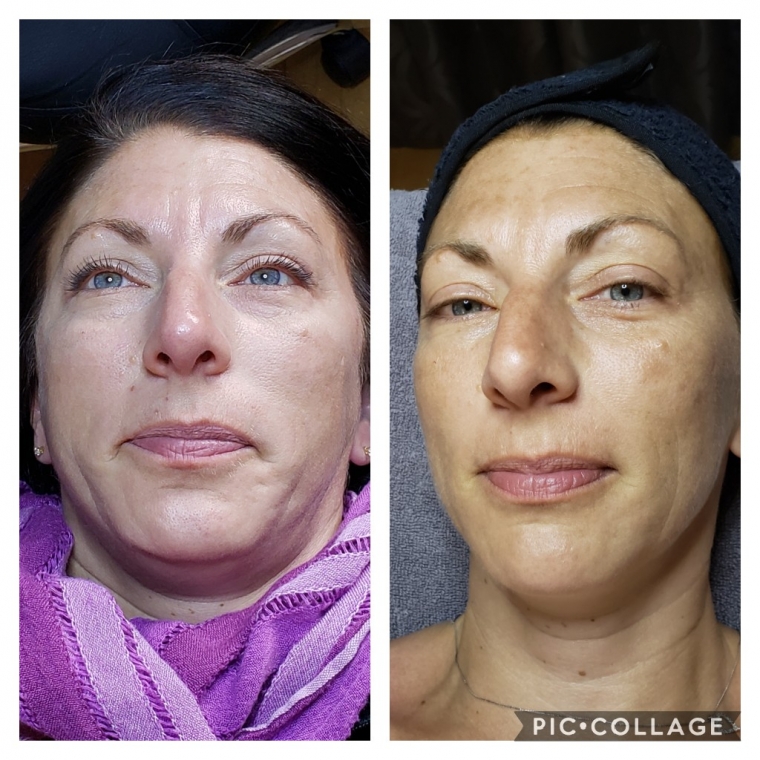 Peeling Image Skincare avant-après