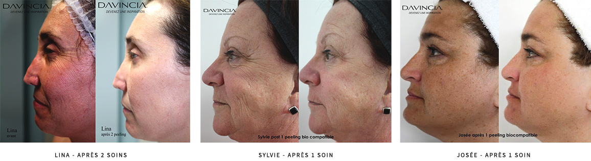 Avant-Après | Soin Bio Compatible Davincia